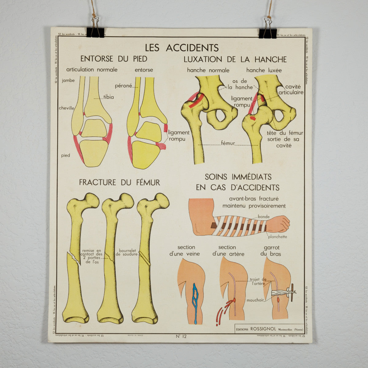 Vintage French School Science Poster- Joints and Fractures
